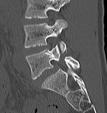 脊椎分離症の術後CT画像２