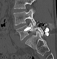 脊椎分離症の術後CT画像２