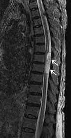 脊髄腫瘍の術前MRI画像