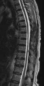 脊髄腫瘍の術後MRI画像
