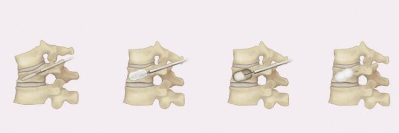 骨折椎体にセメントを注入するバルーン椎体形成術の手術経過