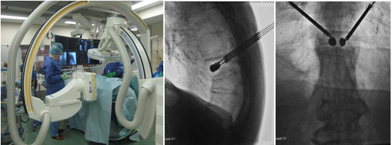 二方向エックス線透視が可能なバイプレーン装置の画像と骨折椎体にセメントを注入するBKPの術中画像