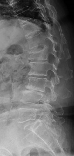 椎体骨折の術前レントゲン画像