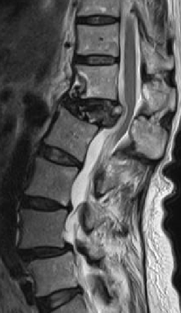 圧潰の強い椎体骨折の術前MRI画像