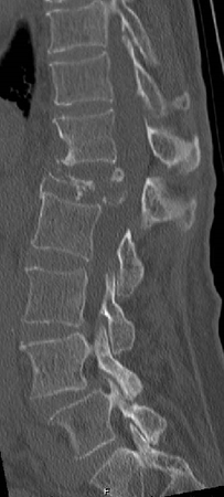 圧潰の強い椎体骨折の術前レントゲン画像
