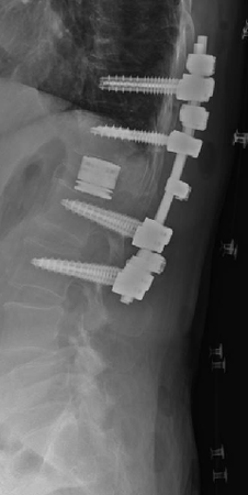 圧潰の強い椎体骨折の術後レントゲン画像１