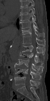 数カ所に及ぶ椎体骨折の術前MRI画像