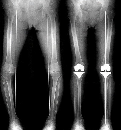 左右のひざ関節を人工関節にしO脚が改善しました