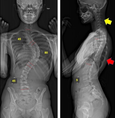 脊柱側弯症のレントゲン画像
