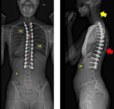 脊柱側弯症の術後レントゲン画像