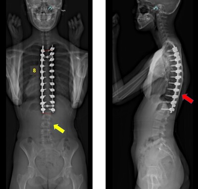 脊柱側弯症の術後レントゲン画像