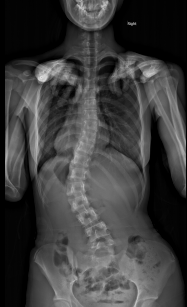 脊柱側弯症の術前レントゲン画像