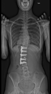 脊柱側弯症の術後レントゲン写真