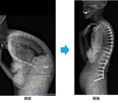 成人脊柱変形の術前と術後画像