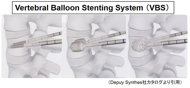 Vertebral Balloon Stenting Systemの画像