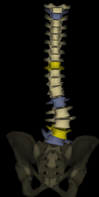 腰椎変性側弯症の術前画像