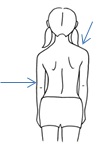 立位で確認できる側弯症の図