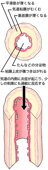 ぜん息患者さんの気道の断面