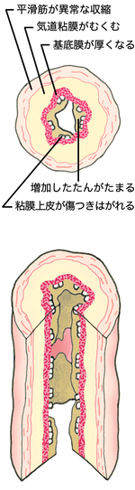 ぜん息発作時の気道の断面