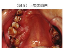 上顎歯肉癌
