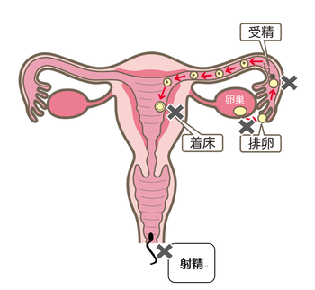 女性の不妊原因についての図