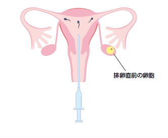 Diagram of artificial insemination