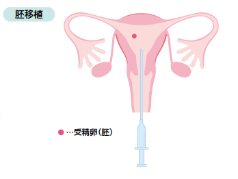 胚移植の図